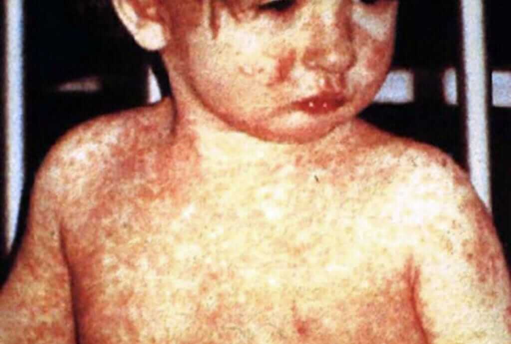 ‘Dial down the hysteria’: doctors say measles fear out of proportion to risk